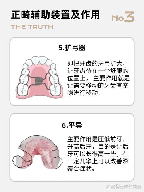 正畸扶8装置要准备哪些-图3
