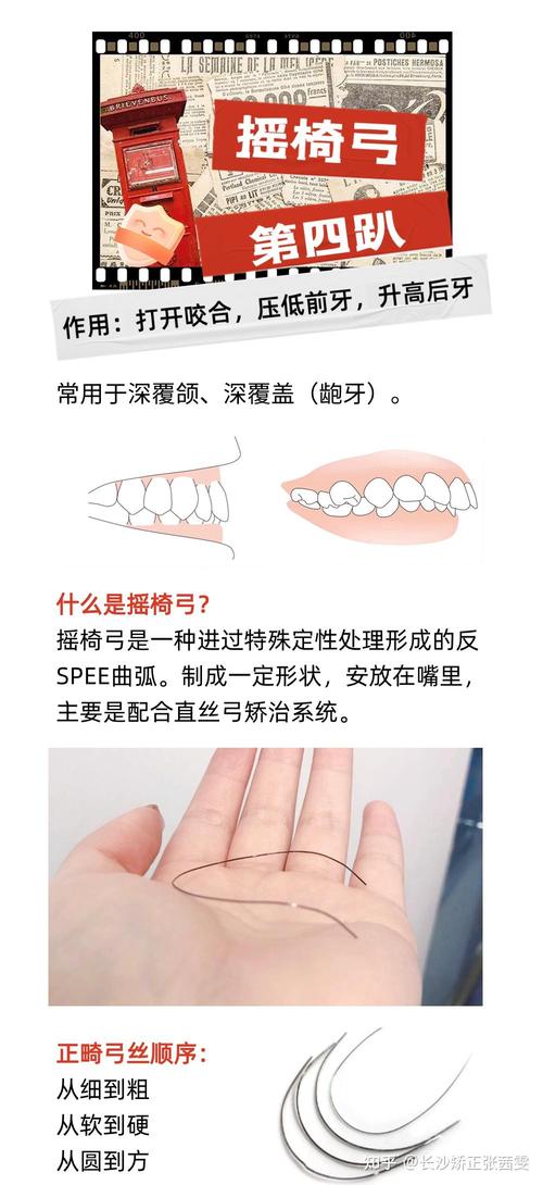 正畸扶8装置要准备哪些-图1