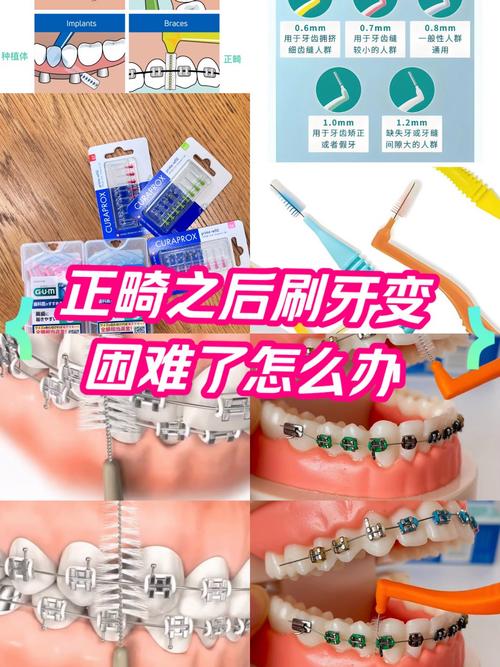 矫治器托槽的去除方法-图1