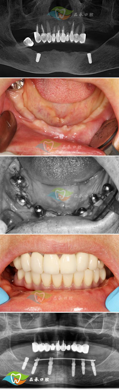 正畸种植钉矫正开合病例，效果怎样？关键点与优势有哪些？-图2