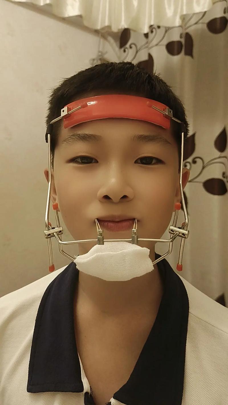 正畸前方牵引器怎么佩戴?教程步骤详解-图1 正畸前方牵引器怎么佩戴?教程步骤详解-图1