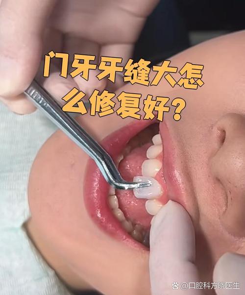 前牙牙缝大如何修补？有哪些有效方法？-图2