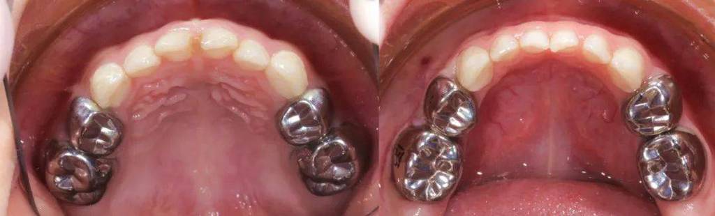 预成冠制备方法的具体步骤是什么？要求需注意哪些关键点？-图2