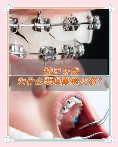 正畸刚用皮筋该用哪个号-图3 正畸刚用皮筋该用哪个号-图3