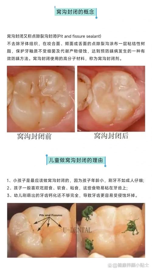 窝沟固化的方法不包括哪些具体操作?-图1 窝沟固化的方法不包括哪些具体操作?-图1