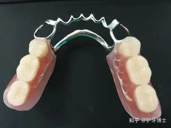 牙齿搭桥的方法好不好-图1 牙齿搭桥的方法好不好-图1