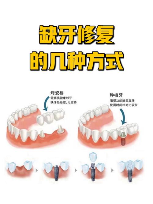 牙齿搭桥的方法好不好-图2 牙齿搭桥的方法好不好-图2