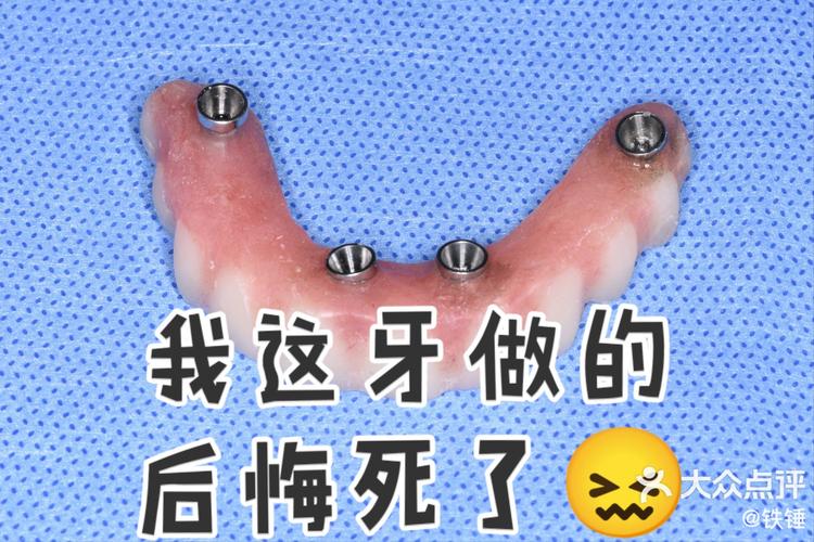 牙齿搭桥的方法好不好-图3 牙齿搭桥的方法好不好-图3