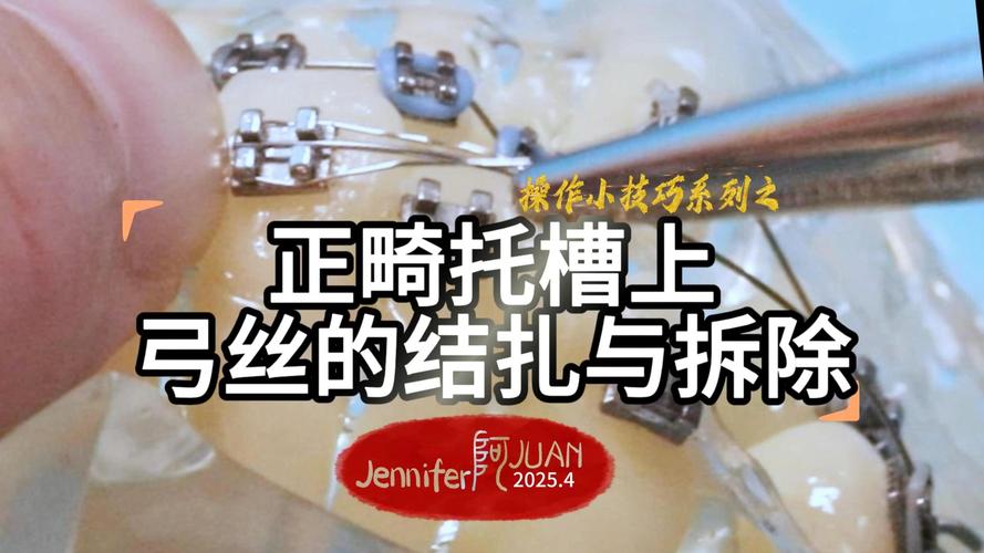 正畸复查时结扎丝如何正确结扎?-图3 正畸复查时结扎丝如何正确结扎?-图3