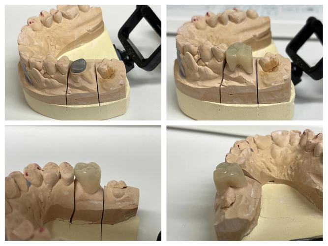 增加桩核固位的方法中-图1
