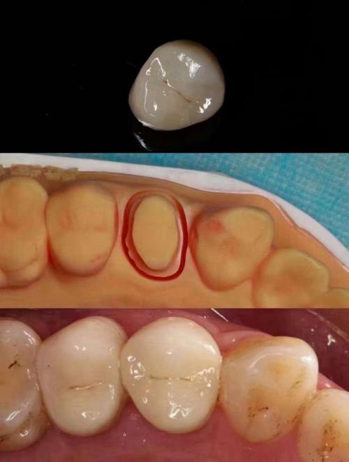 全瓷义齿内冠染色方法如何实现自然美观与持久效果?-图1 全瓷义齿内冠染色方法如何实现自然美观与持久效果?-图1