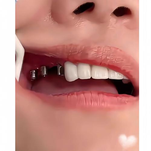 种牙后的牙齿图片大全能看出哪些真实效果？美观度和自然度跟真牙比如何？-图2