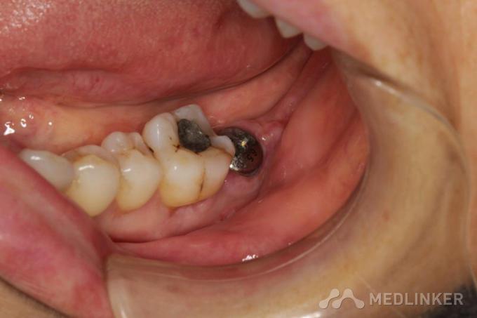 种牙后的牙齿图片大全能看出哪些真实效果?美观度和自然度跟真牙比如何?-图1 种牙后的牙齿图片大全能看出哪些真实效果?美观度和自然度跟真牙比如何?-图1