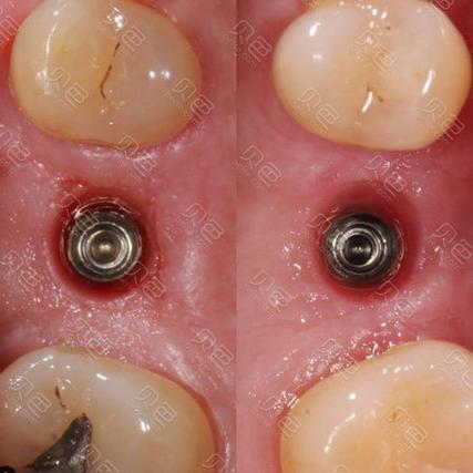 种牙后的牙齿图片大全能看出哪些真实效果?美观度和自然度跟真牙比如何?-图3 种牙后的牙齿图片大全能看出哪些真实效果?美观度和自然度跟真牙比如何?-图3