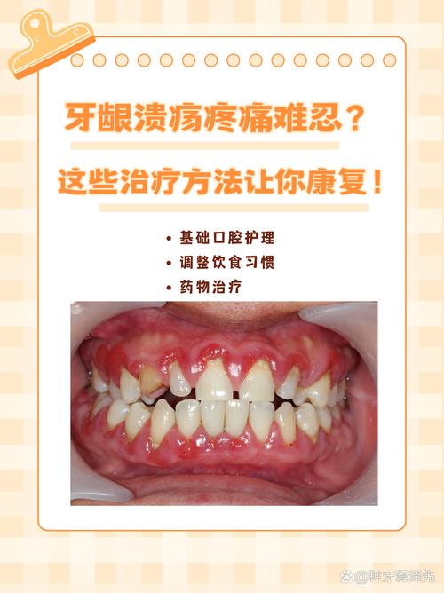 口腔溃疡能种牙吗?-图1 口腔溃疡能种牙吗?-图1