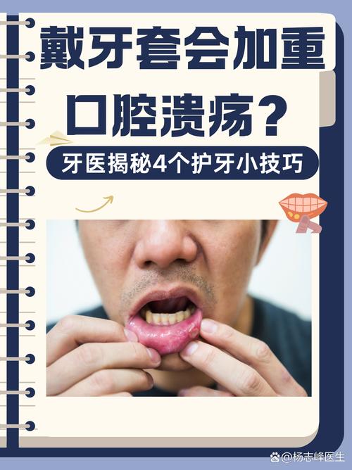 口腔溃疡能种牙吗?-图2 口腔溃疡能种牙吗?-图2