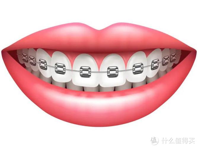 正畸矫正必须所有牙都粘托槽吗？-图2