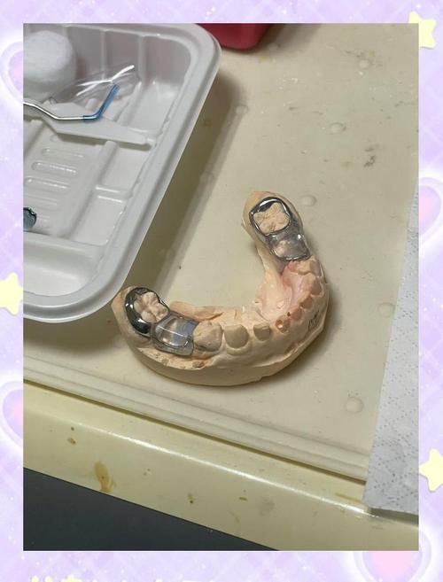 保持器的弯制方法正畸-图2