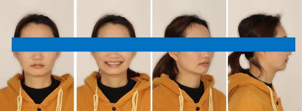 口腔正畸面相照拍摄角度如何确定？-图1