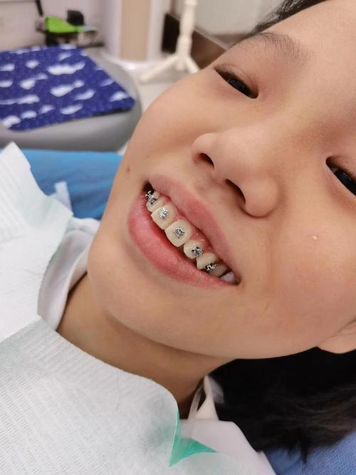 儿童10岁前牙齿正畸为何宜早不宜迟?-图2 儿童10岁前牙齿正畸为何宜早不宜迟?-图2