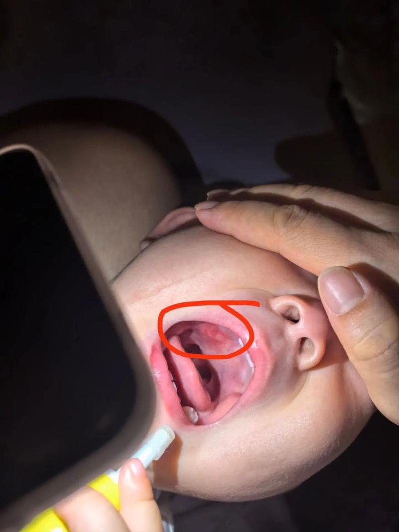 两岁宝宝口腔溃疡,拜博能治好吗?-图1 两岁宝宝口腔溃疡,拜博能治好吗?-图1