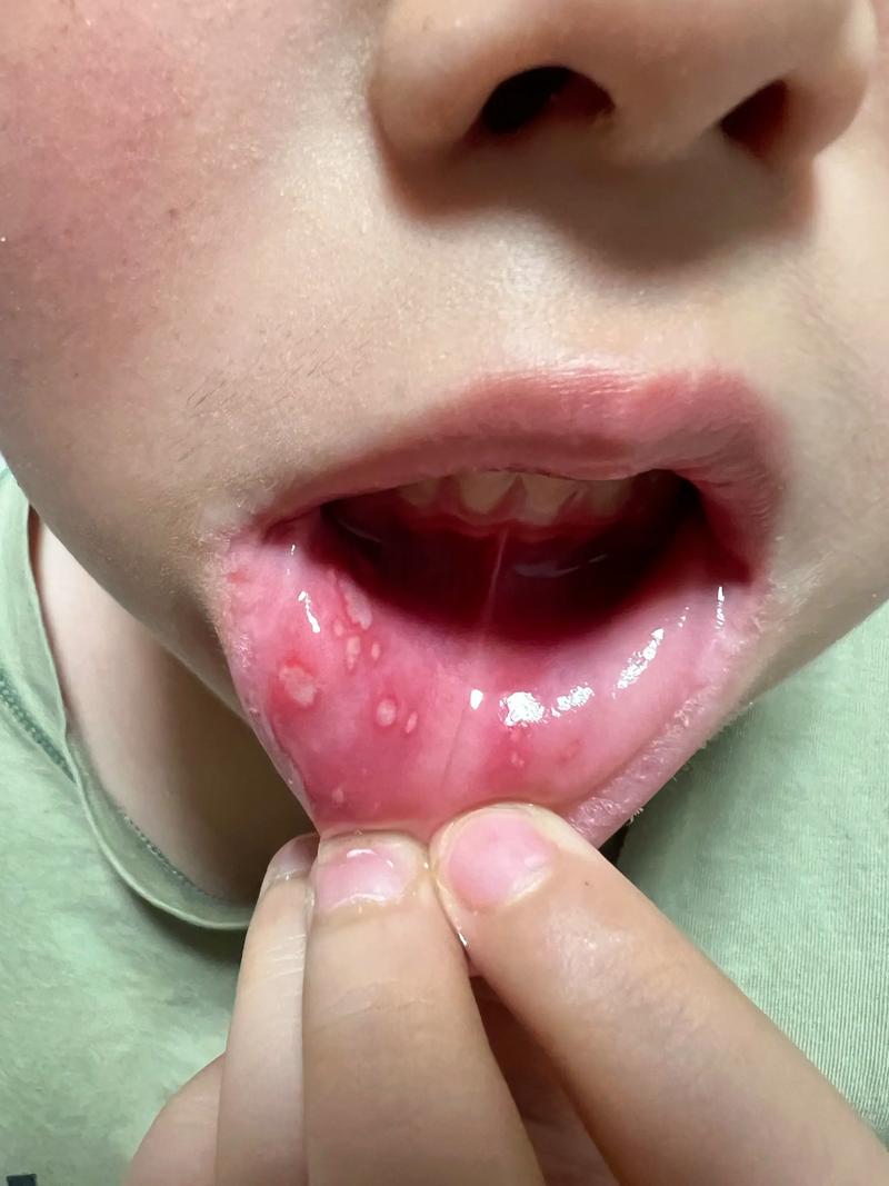 两岁宝宝口腔溃疡,拜博能治好吗?-图2 两岁宝宝口腔溃疡,拜博能治好吗?-图2