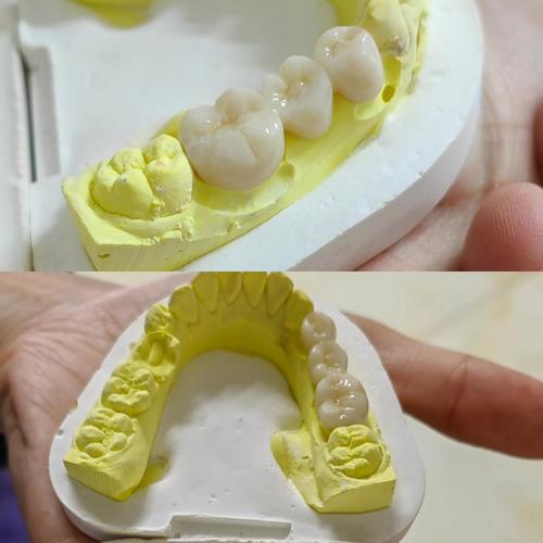 拜博口腔烤瓷牙做得怎么样?效果、价格和技术靠谱吗?-图2 拜博口腔烤瓷牙做得怎么样?效果、价格和技术靠谱吗?-图2