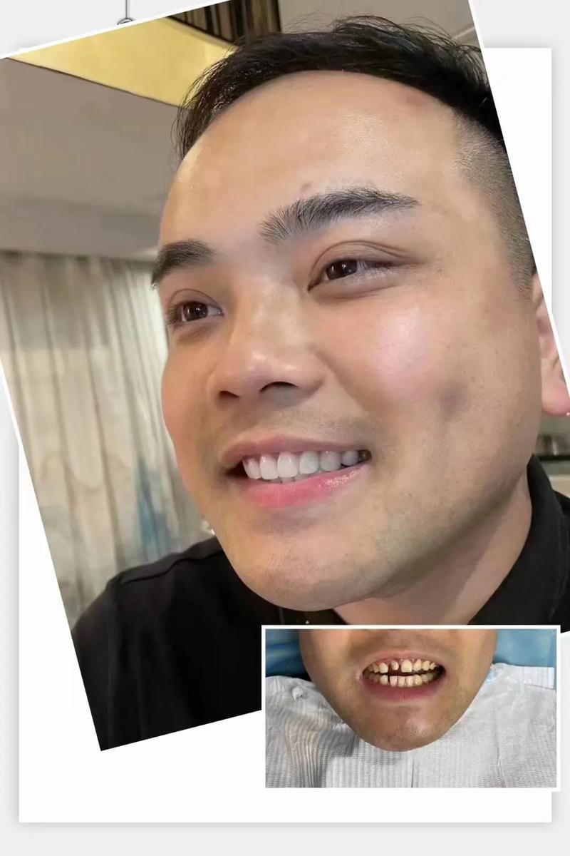 拜博口腔烤瓷牙做得怎么样?效果、价格和技术靠谱吗?-图3 拜博口腔烤瓷牙做得怎么样?效果、价格和技术靠谱吗?-图3