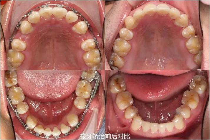 正畸减数拔牙是什么意思-图1 正畸减数拔牙是什么意思-图1