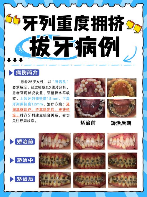 正畸减数拔牙是什么意思-图2