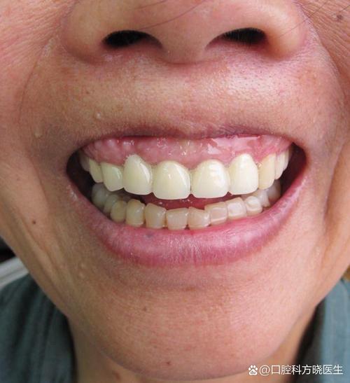 33岁 有烤瓷牙 正畸-图2 33岁 有烤瓷牙 正畸-图2