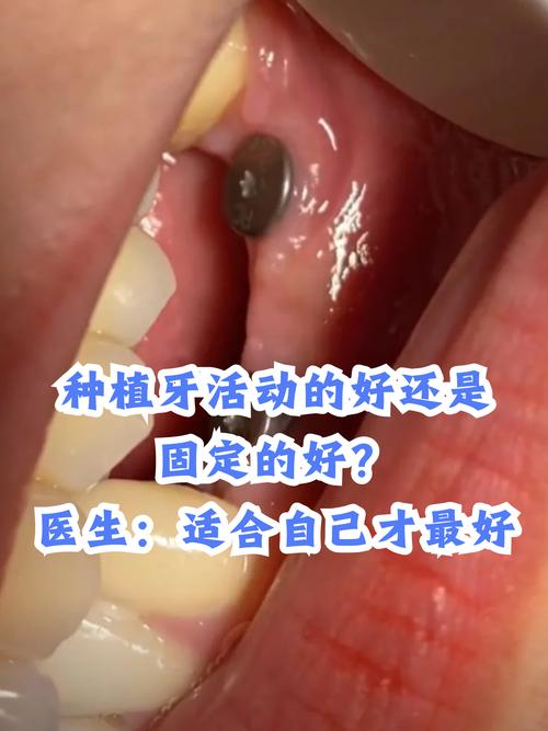 无锡口腔医院种牙效果如何？真实评价靠谱吗？-图3