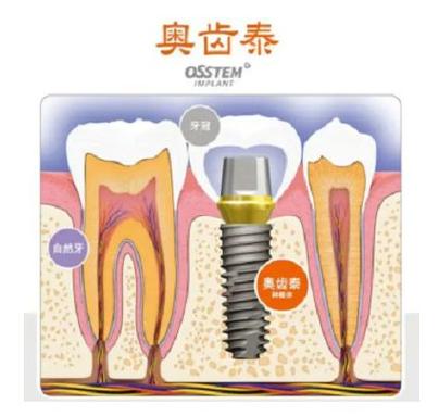 德国种植牙是即时种吗-图2