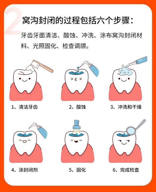 窝沟封闭的方法和步骤是怎样的？具体操作流程如何？-图2