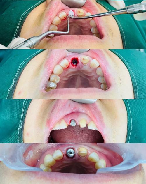 青岛亚美口腔医院种牙效果怎么样?技术靠谱吗?价格贵不贵?-图3 青岛亚美口腔医院种牙效果怎么样?技术靠谱吗?价格贵不贵?-图3