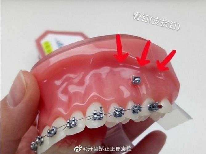 正畸支抗钉可以重复使用吗?重复使用的安全性与效果如何?-图3 正畸支抗钉可以重复使用吗?重复使用的安全性与效果如何?-图3