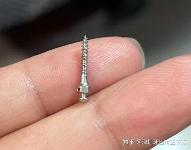 正畸支抗钉可以重复使用吗?重复使用的安全性与效果如何?-图1 正畸支抗钉可以重复使用吗?重复使用的安全性与效果如何?-图1