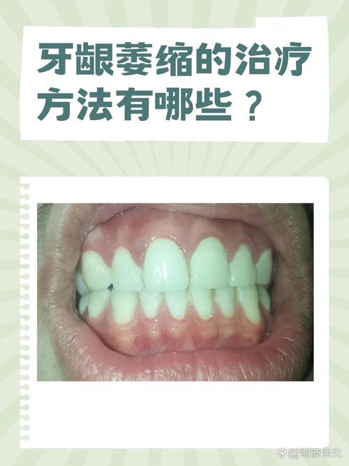 种牙后牙龈萎缩为何会发生？这些原因你需要了解吗？-图2