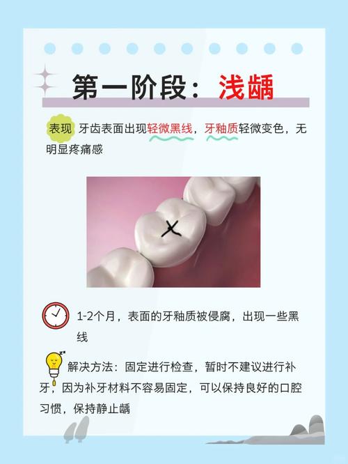 龋病的治疗方法有哪些?不同龋齿程度如何选择合适的治疗方式?-图2 龋病的治疗方法有哪些?不同龋齿程度如何选择合适的治疗方式?-图2