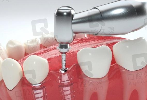 上海拜博口腔植牙价格效果如何?技术靠谱吗?-图1 上海拜博口腔植牙价格效果如何?技术靠谱吗?-图1
