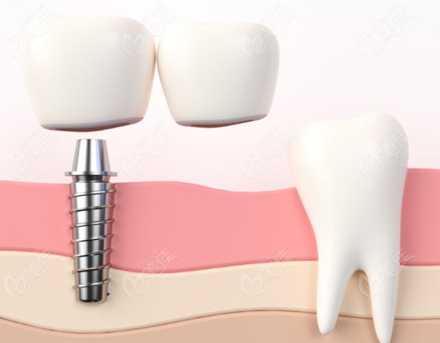上海拜博口腔植牙价格效果如何?技术靠谱吗?-图2 上海拜博口腔植牙价格效果如何?技术靠谱吗?-图2