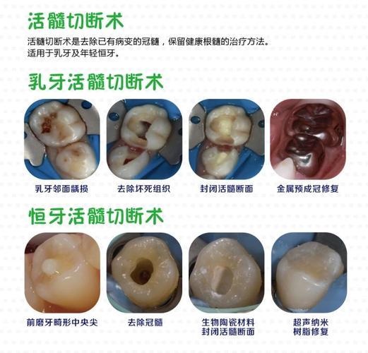 保存活髓的治疗方法有哪些?各自适用情况及优缺点是什么?-图3 保存活髓的治疗方法有哪些?各自适用情况及优缺点是什么?-图3