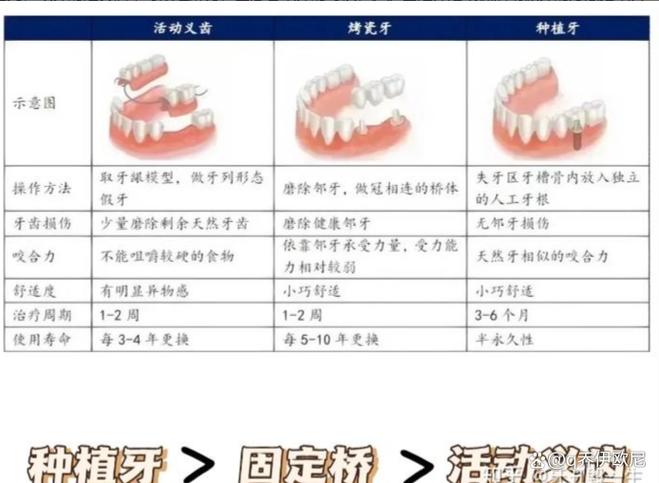 青年种牙好还是镶牙好-图3 青年种牙好还是镶牙好-图3