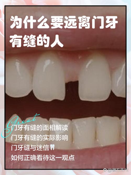 门牙牙缝变小的方法有哪些?-图3 门牙牙缝变小的方法有哪些?-图3