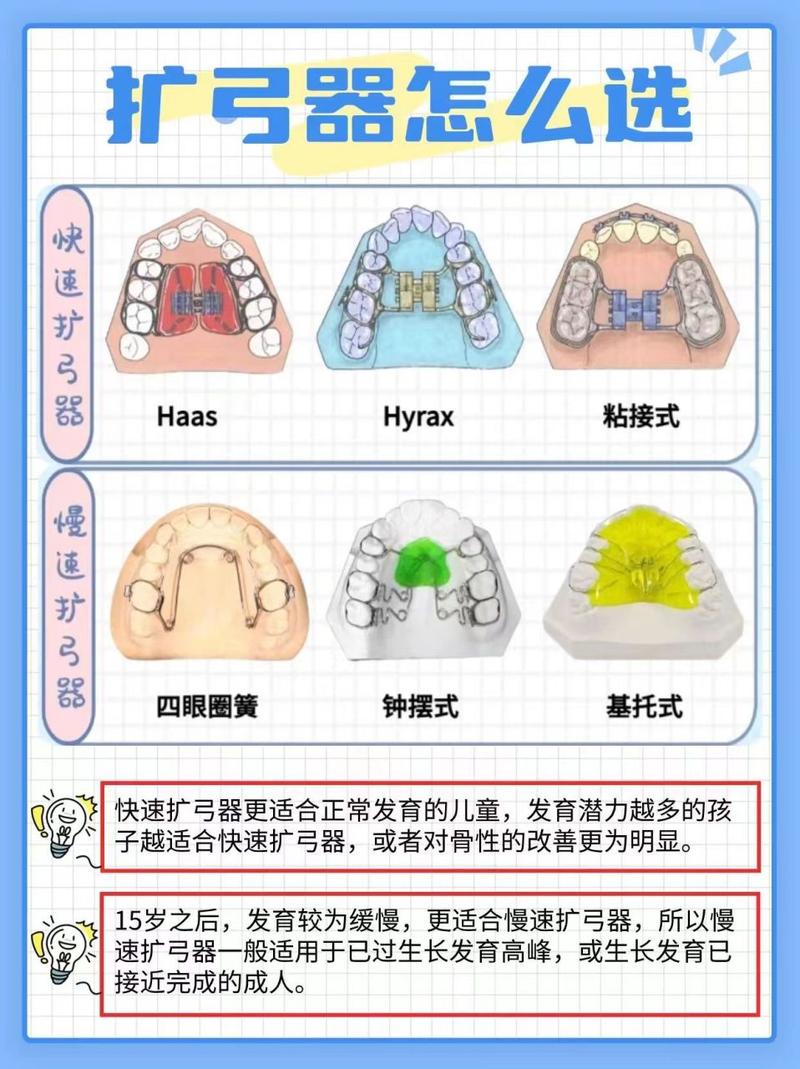 固定矫正期内扩弓方法-图3