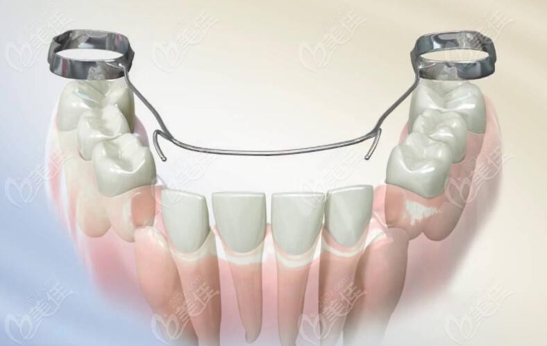 正畸横腭杆弯制方法的关键步骤、操作技巧及注意事项有哪些？-图2