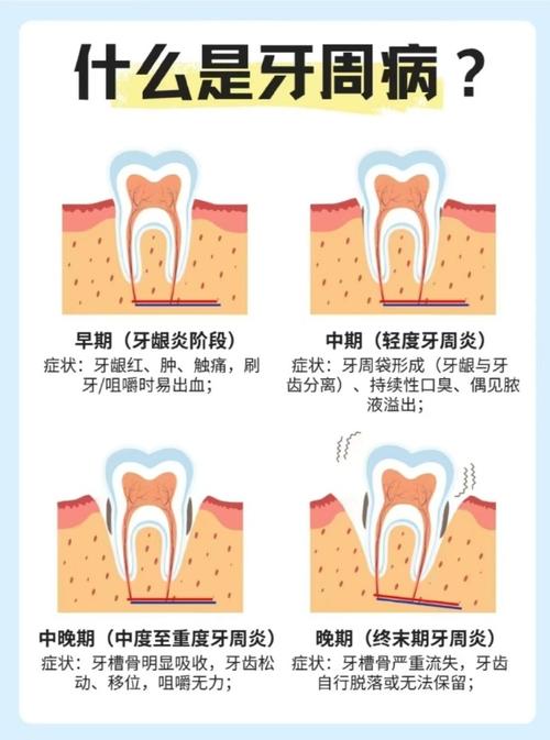 侵袭性牙周炎患者种牙可行吗?需满足哪些前提条件?-图3 侵袭性牙周炎患者种牙可行吗?需满足哪些前提条件?-图3