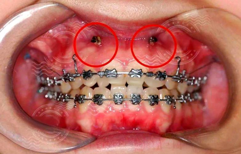 牙齿正畸 不用打钉子吧-图2 牙齿正畸 不用打钉子吧-图2