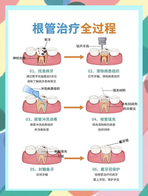 牙齿疼根管的治疗方法-图1 牙齿疼根管的治疗方法-图1