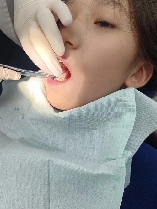 杭州口腔医院儿童正畸，孩子几岁开始矫正效果最佳？-图1